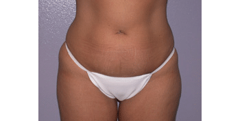 Before Image: Liposuction - front