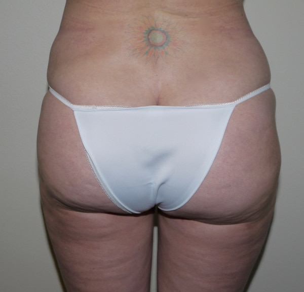 After Image: Liposuction - back