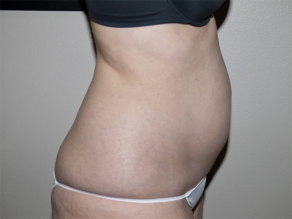 Before Image: Liposuction - right-side