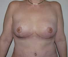 After Image: Breast Lift - front