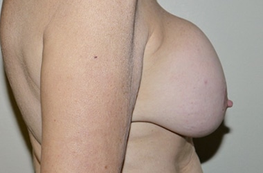 Before Image: Breast Implant Removal with Lift - right-side