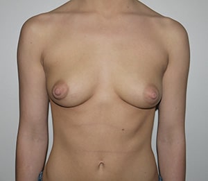 Before Image: Breast Augmentation - front