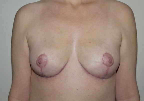 After Image: Breast Implant Removal with Lift - front