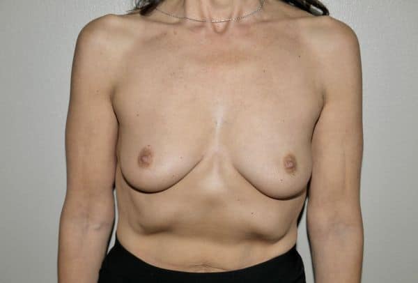 Before Image: Breast Augmentation - front