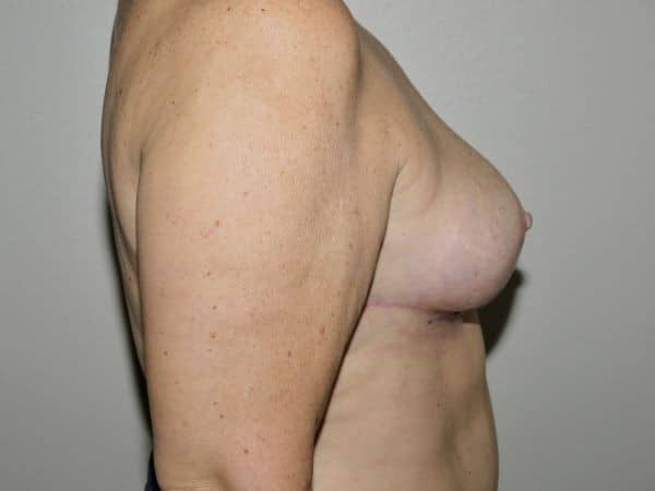 After Image: Breast Implant Removal with Lift - right-side