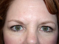 Before Image: Forehead Lift - front