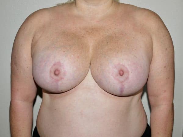 After Image: Breast Lift with Augmentation - front