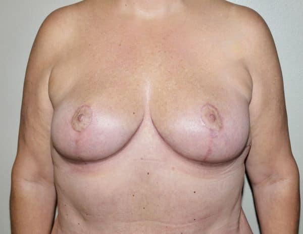 After Image: Breast Lift - front