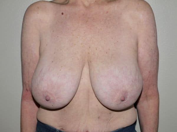 Before Image: Breast Implant Removal with Lift - front