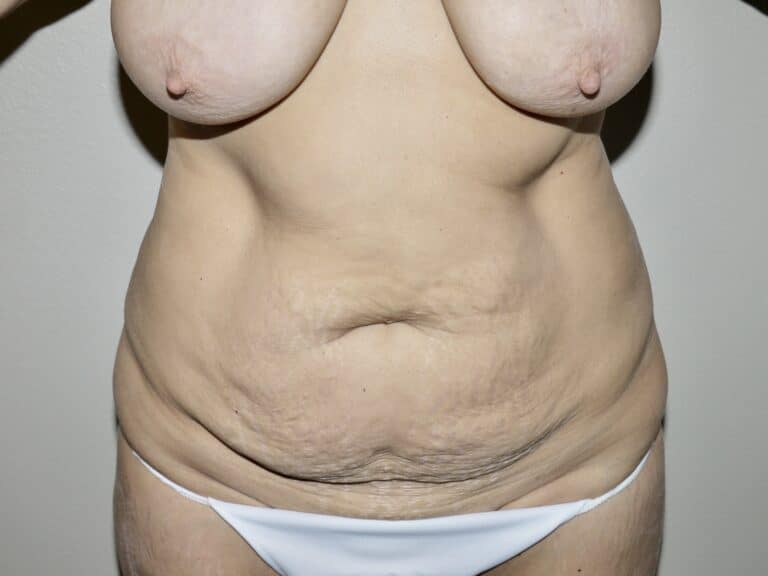 Before Image: Abdominoplasty - front