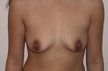 Before Image: Breast Augmentation - front