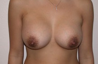 After Image: Breast Augmentation - front