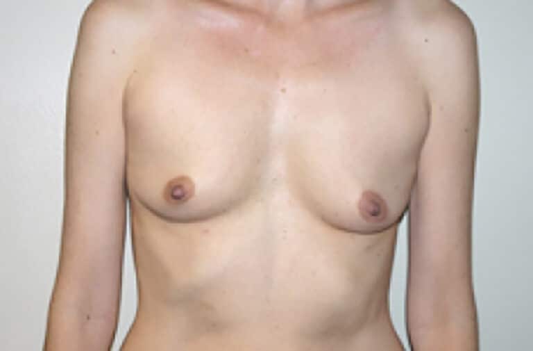 Before Image: Breast Augmentation - front