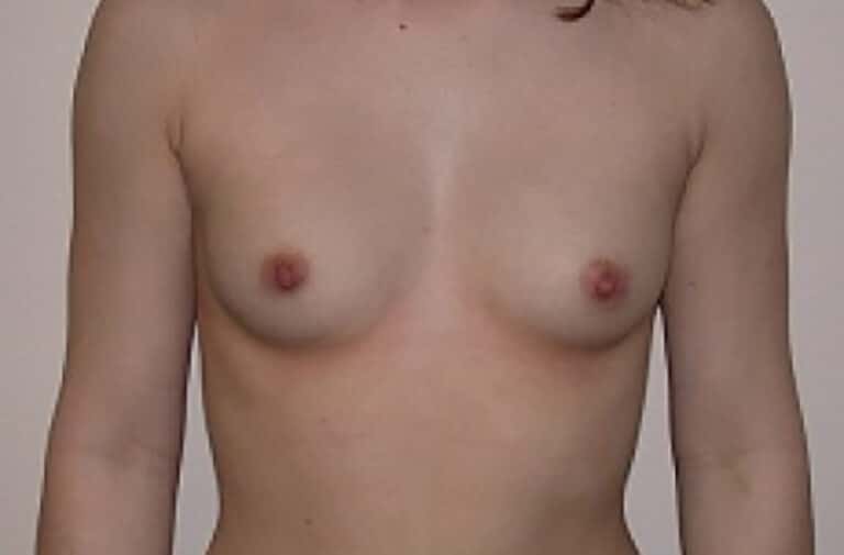 Before Image: Breast Augmentation - front