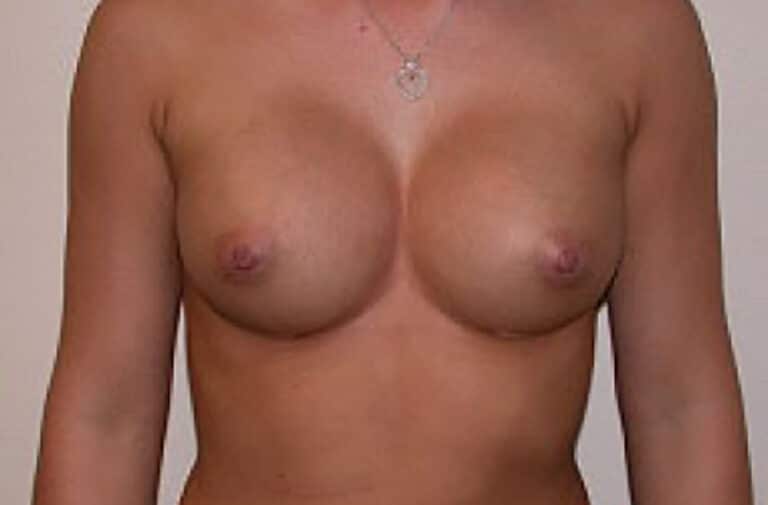 After Image: Breast Augmentation - front