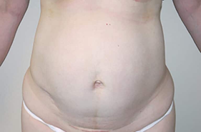 Before Image: Abdominoplasty - front