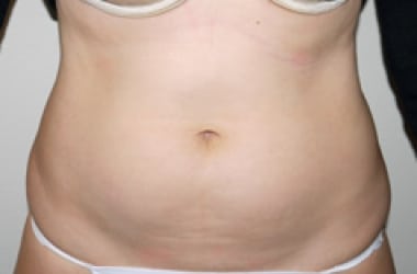 Before Image: Liposuction - front