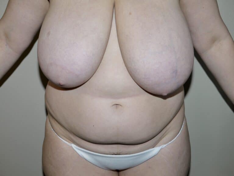 Before Image: Liposuction - front