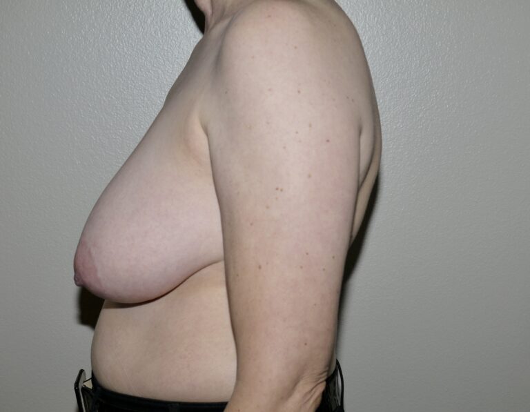 Before Image: Breast Reduction -