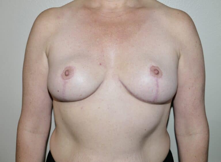 After Image: Breast Implant Removal with Lift - front