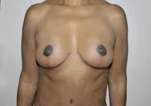 After Image: Breast Lift