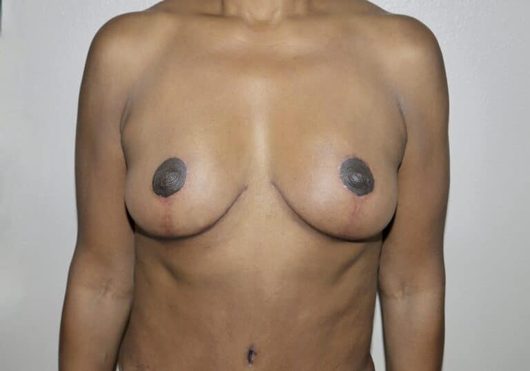 After Image: Breast Lift - front