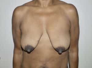 Before Image: Breast Lift