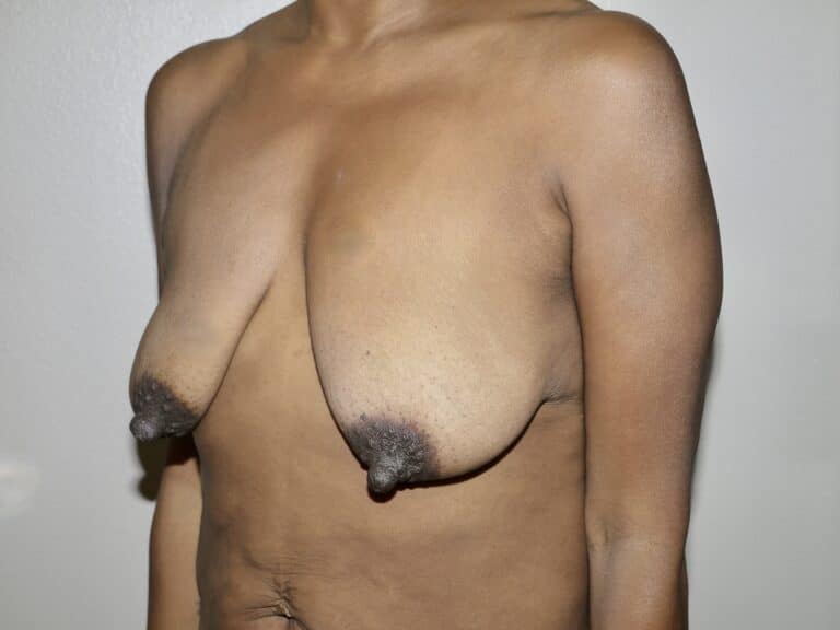 Before Image: Breast Lift - left-front-oblique