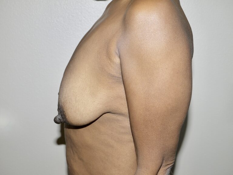 Before Image: Breast Lift - left-side