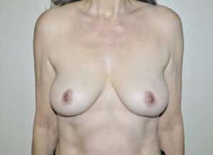 Before Image: Breast Reduction