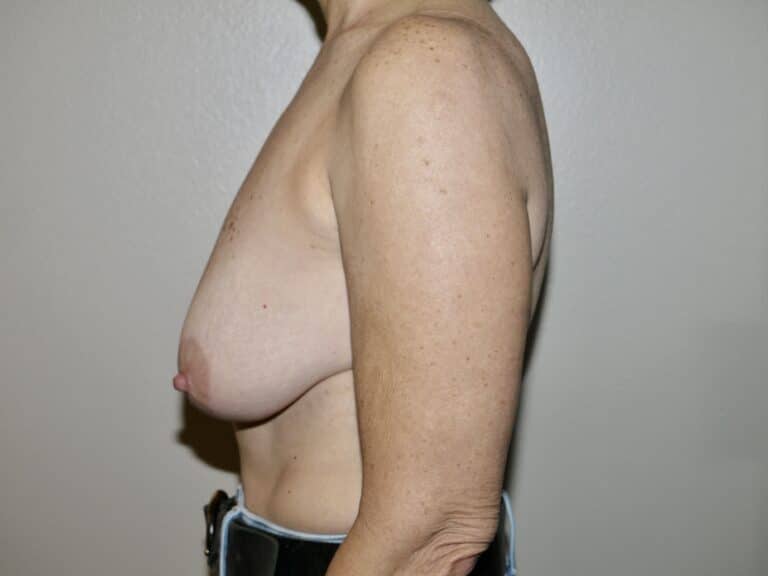 Before Image: Breast Lift - left-side