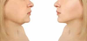 Before and after chin lipo in Las Vegas