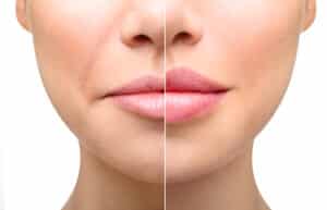 Lip Enhancement in Las Vegas: From Thin to Plump