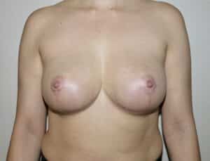 After Image: Breast Implant Removal with Lift