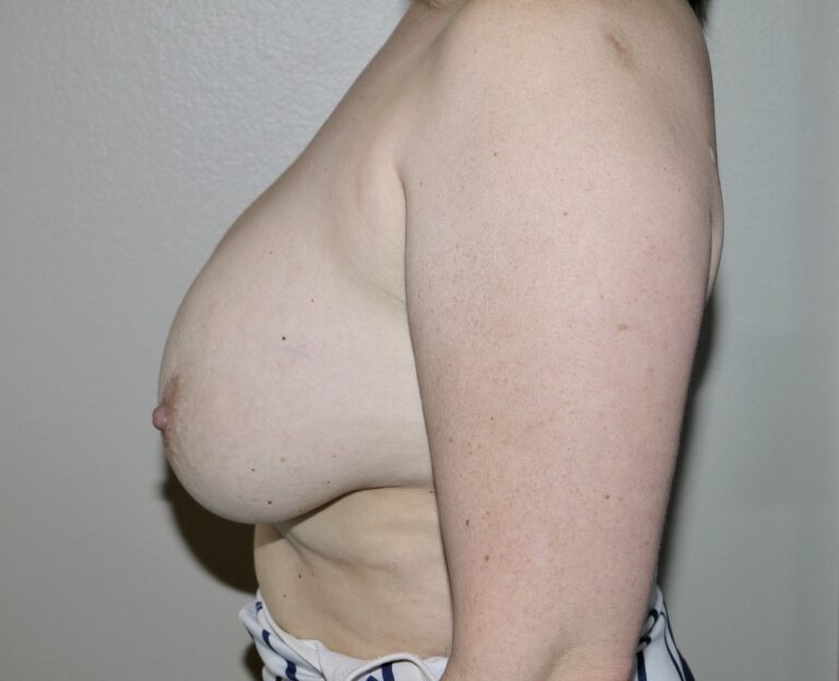 Before Image: Breast Implant Removal with Lift - left-side