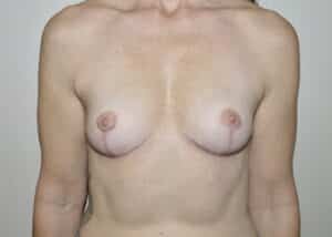 After Image: Breast Implant Removal with Lift