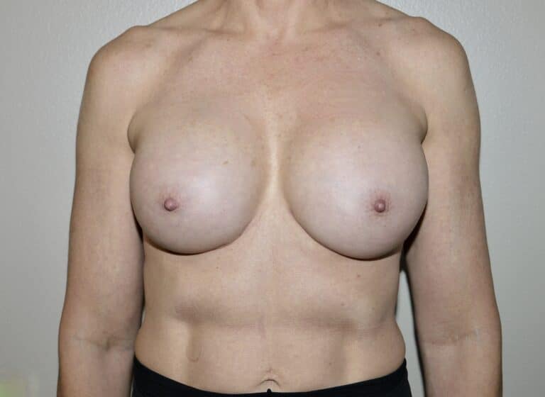 After Image: Breast Implant Revisions - front