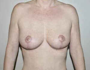 After Image: Breast Implant Removal with Lift