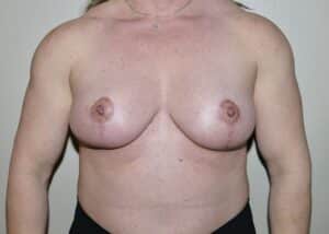 After Image: Breast Lift